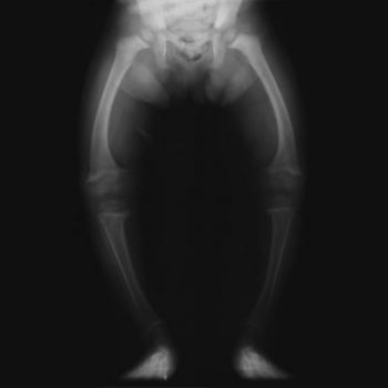 XrayRicketsLegssmall