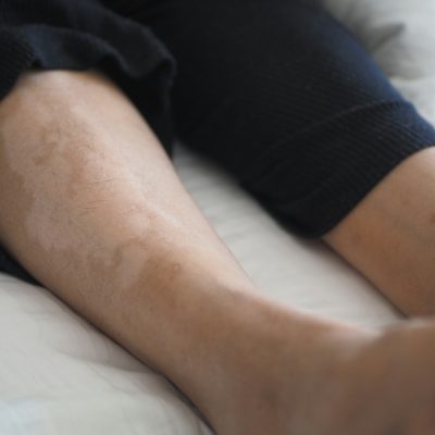 feet with vitiligo skin condition.
